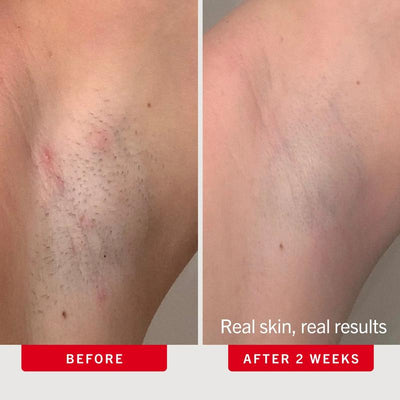 Smooth Skin™ Bump & Ingrown Duo