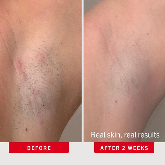 Smooth Skin™ Bump & Ingrown Duo